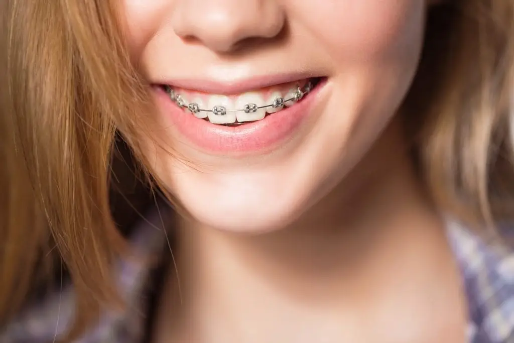 girl with braces smiling - practice tepper